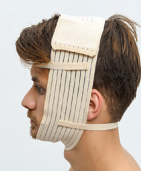 Steznik nakon facelifting-a 01