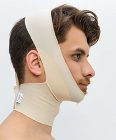 Steznik nakon facelifting-a 03